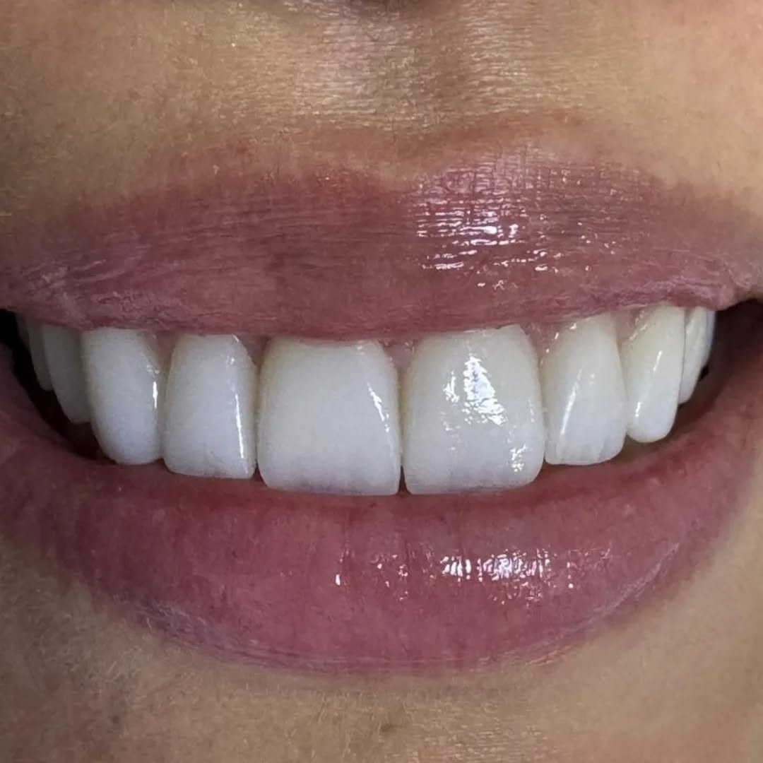 🦷 Artículo Clínico #1: Estética